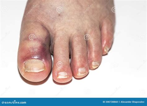 close   bruise injury  female leg background stock photography