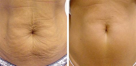 Radiofrequência Antes E Depois Barriga - Radiofrequência ~ Dra Marlene Costa