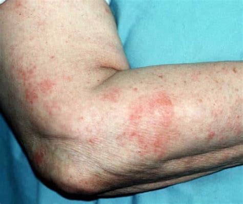 Find Relief from Eczema with Natural Skincare - T99M: Where Cutting ...