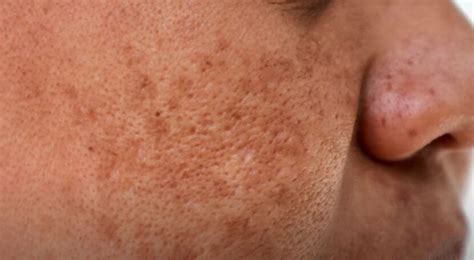 home remedies  skin discoloration  dark skin