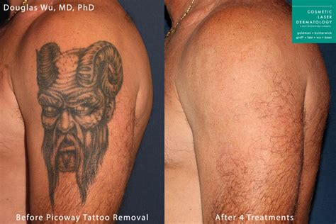 Top more than 58 tattoo removal methods - in.cdgdbentre