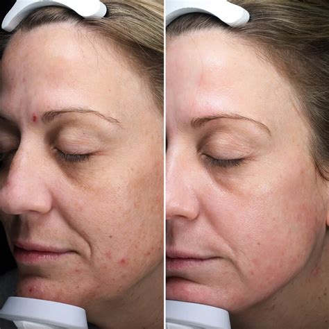 laser tattoo removal face 2