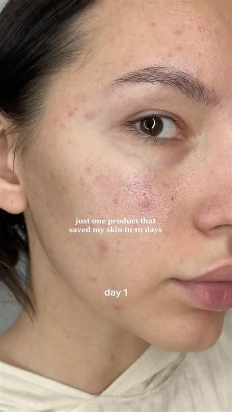 la roche-posay serum [Video] | Gezicht producten, Huidproducten ...