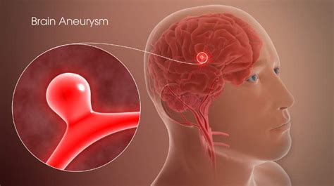 Brain Aneurysm Surgery India: Causes, Procedure, Hospitals