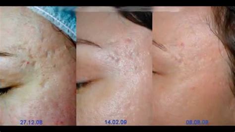 Мезороллер эффект до и после!! Maso Derma Roller - YouTube