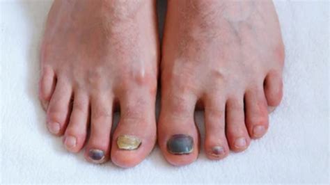 Toenail Discolouration: What Causes It And Ways To Treat It | OnlyMyHealth