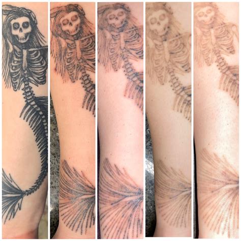 Tattoo Removal