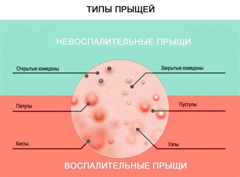 Прыщи на лице: симптомы, причины и лечение в домашних условиях