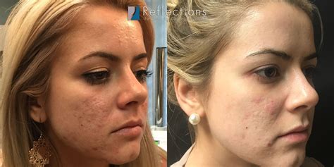 RF Microneedling for Acne Scars Results Super-Charged! Before & After ...