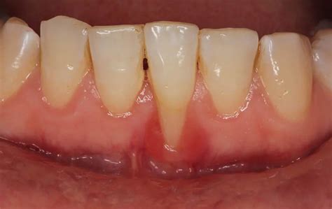 Exposed Root of Tooth: Causes, Symptoms, and Treatment - Medical Blog