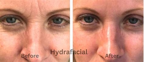 morpheus radio frequency micro needling    picture
