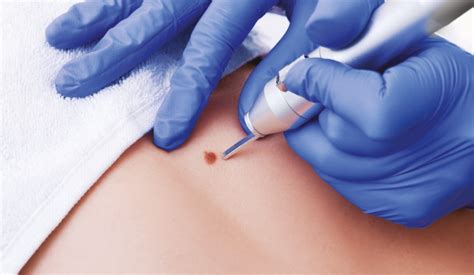 Treating Skin Lesions - Aesthetics