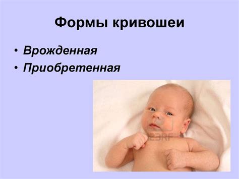 Врожденная мышечная кривошея - презентация онлайн