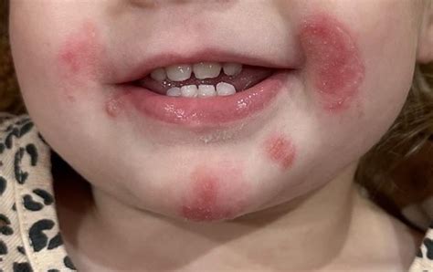 Rash on toddler face : r/DermatologyQuestions