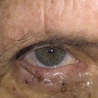 intraoperative photograph demonstrates eyelid margin position