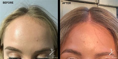 All You Need to Know About Hairline Lowering Surgery