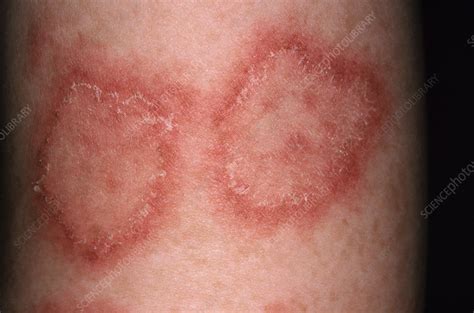 Discoid Lupus - Stock Image - C003/1307 - Science Photo Library