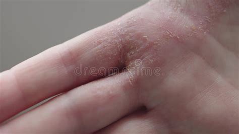 Dermatitis Hands Palm Skin Itchy Scratches on Dry Skin Female Hands ...