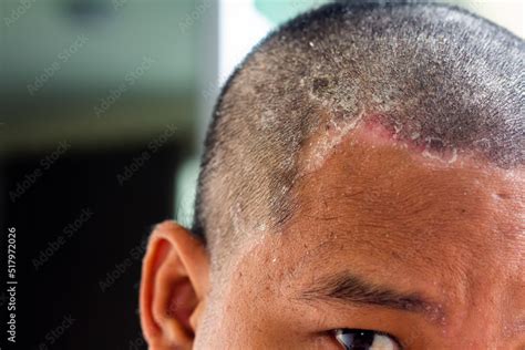 skin disease   head dandruff   common condition