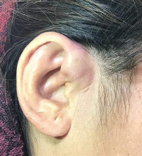 Preauricular sinus - EarAidNepal