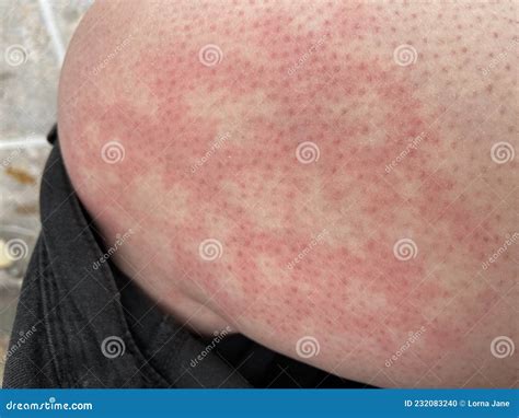 тепловая сыпь ульи реакция аллергии на колено закрывает эталонное ...