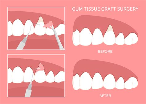 Can You Get Gum Graft With Braces at Ariel Sipes blog