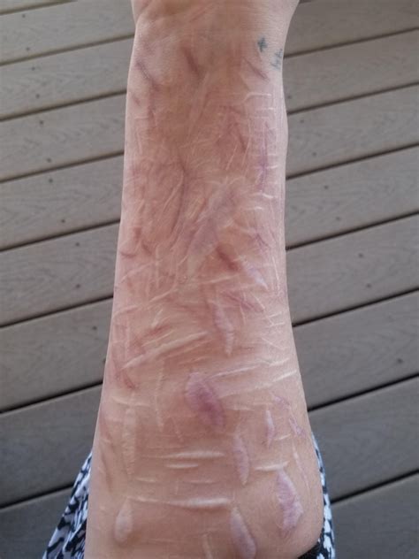 leg scars - will they fade anymore? they are rlly old :( tw they are ...