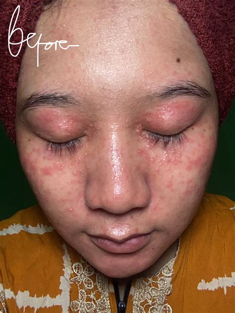 DERMATITIS PERIORAL | Galeri diposting oleh Devi.dry | Lemon8