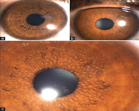 Iris nodules in Fuchs heterochromic iridocyclitis : Indian Journal of ...