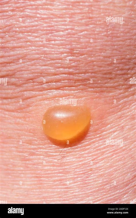 Allergic reaction to an insect bite under the knee of a 60 year old ...