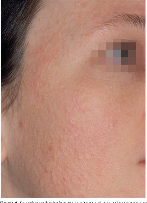 structure  vellus hair semantic scholar