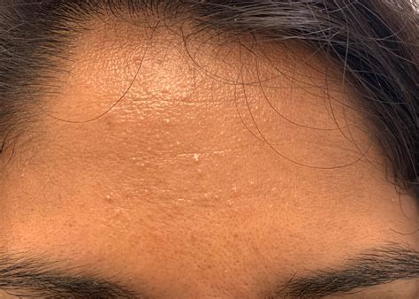 [Skin Concern][ACNE] Closed comedones problem and looking for setting