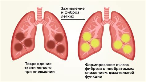 Что такое фиброз легких и чем он опасен для человека