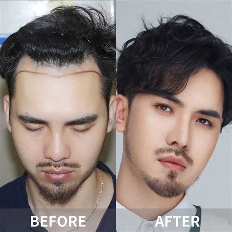 Hair Transplant Cost | Finding Quality Results at Affordable Prices