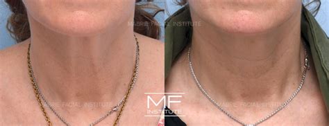 Situações De Convívio Em Diferentes Lugares 1o Ano Atividades - Neck Banding Before and After Pictures Case 860 | San Francisco, CA ...