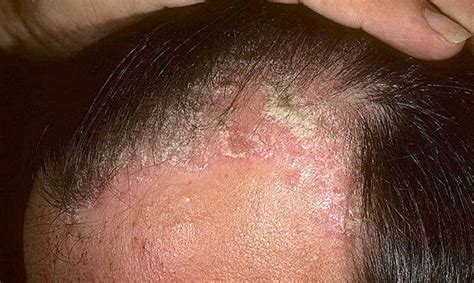 Signs Of Scalp Psoriasis