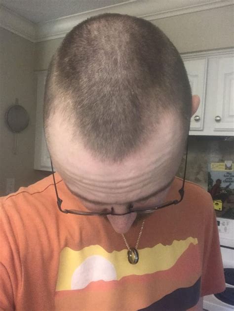M30 high hairline/widows peak or balding? : r/Hairloss
