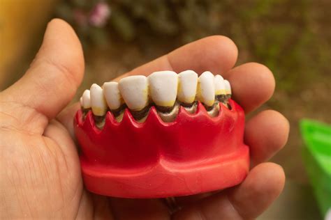 How to Brush Your Teeth After Wisdom Teeth Extraction: Sunridge