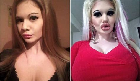 Bulgarian Woman Gets 20th Injection In Bid To Get World's Biggest Lips