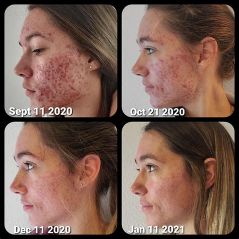 Accutane Before During And After