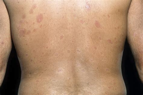 Systemic Sclerosis Clinical Features - Rare Disease Advisor