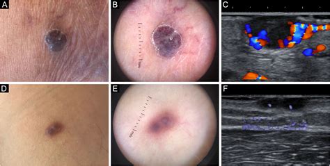 Sarcoma De Kaposi Fotos 7