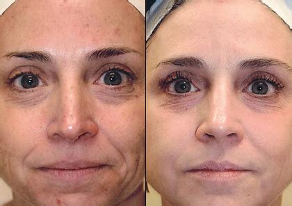 Broad Band Light (BBL™) Forever Young Treatment Perth - COCO Skin