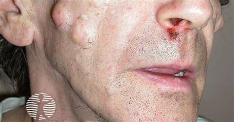 Gardner syndrome image