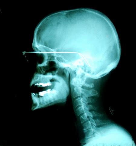 X-ray - electromagentic radiation, rontgen rays, radiography