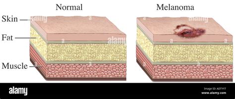 Melanoma Skin Cancer Cell