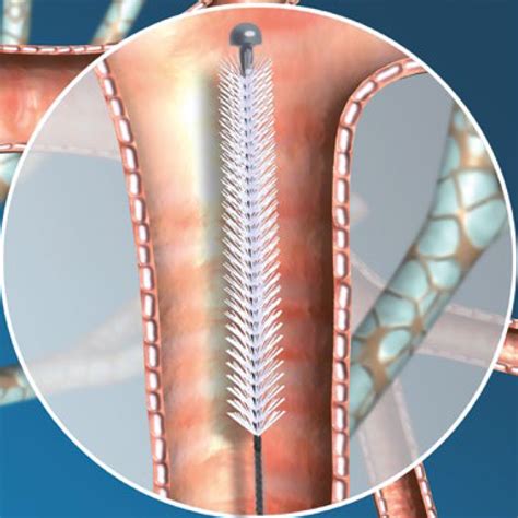 cytology brushes micro tech uk