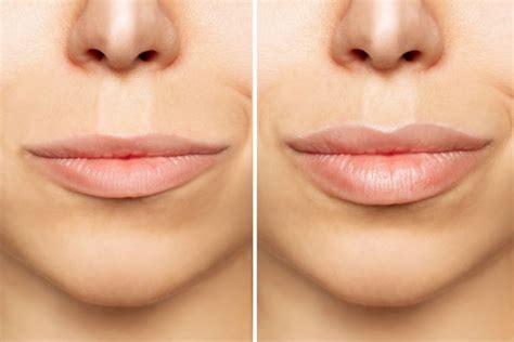 A Boca Volta Ao Normal Depois Do Preenchimento Labial - Como é o antes e depois do preenchimento labial?