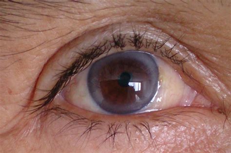 Arcus Senilis - Ophthalmology Education blog - Ophthalmology Education ...