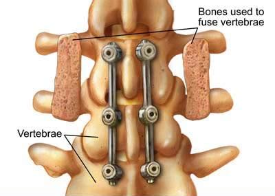 Lumbar Spine Surgery | Bone and Spine